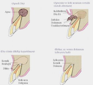 apikal rezeksiyon