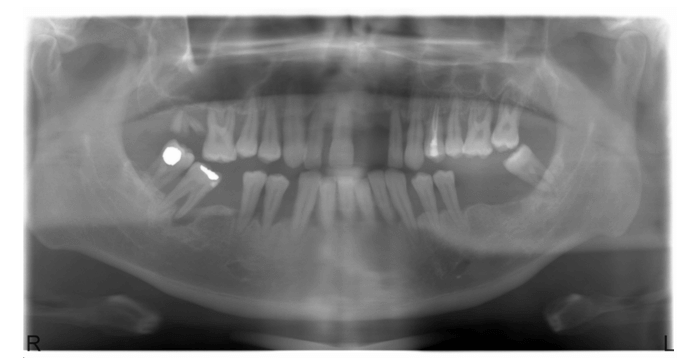 implant panaromik