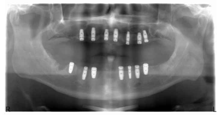 implant takildiktan sonra