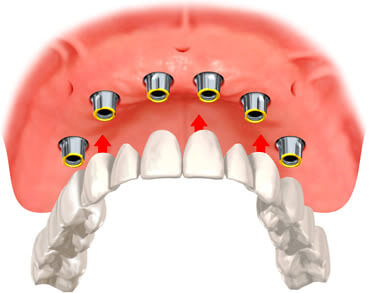 implant protez