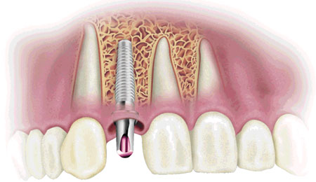 dis eti iltihabi implant