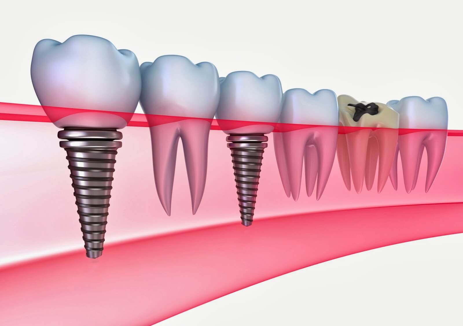 implant diş tedavisi