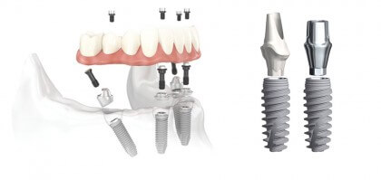 implant dental