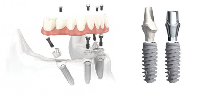 implant dental