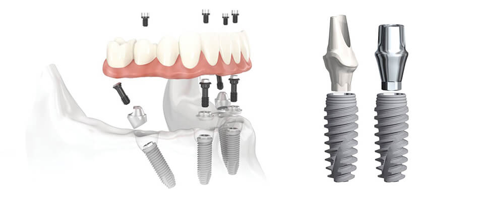 implant dental - implantın aşamaları