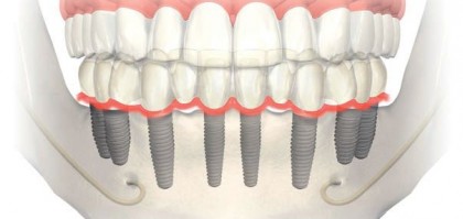 implant fiyatları