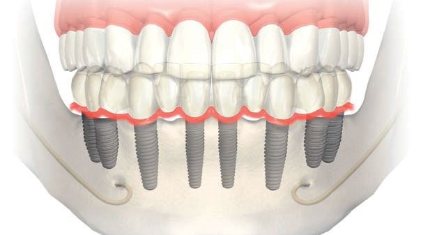 implant fiyatları