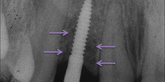 implant sakincasi