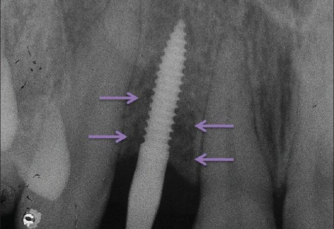 implant sakincasi