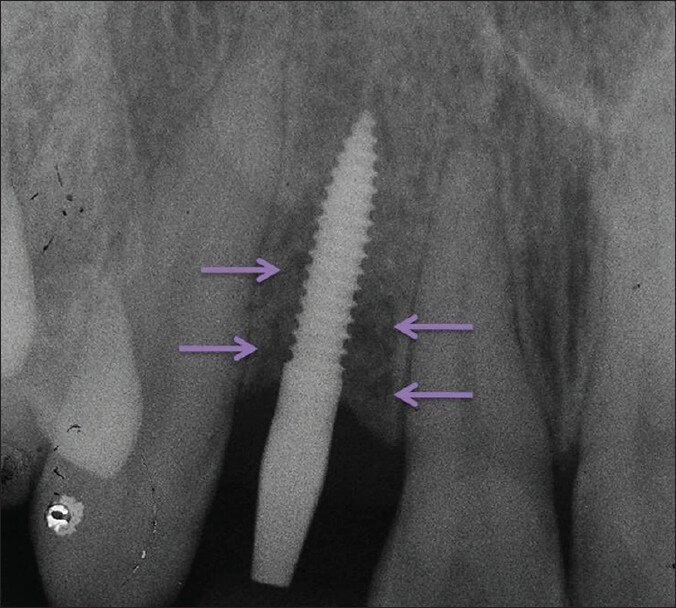 implant sakincasi