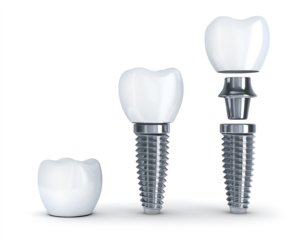 implant nasıl sabitlenir