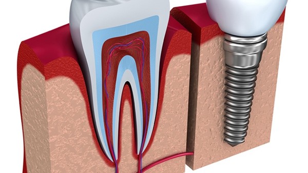 implantın avantajları