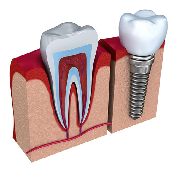 implantın avantajları