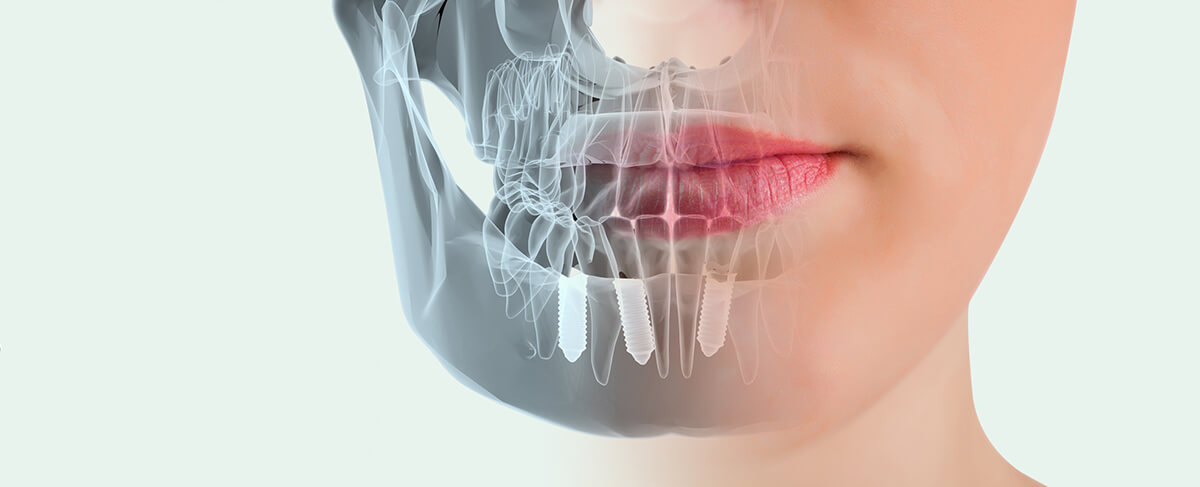 implantın uzun ömürlü olması için neler yapılmalı