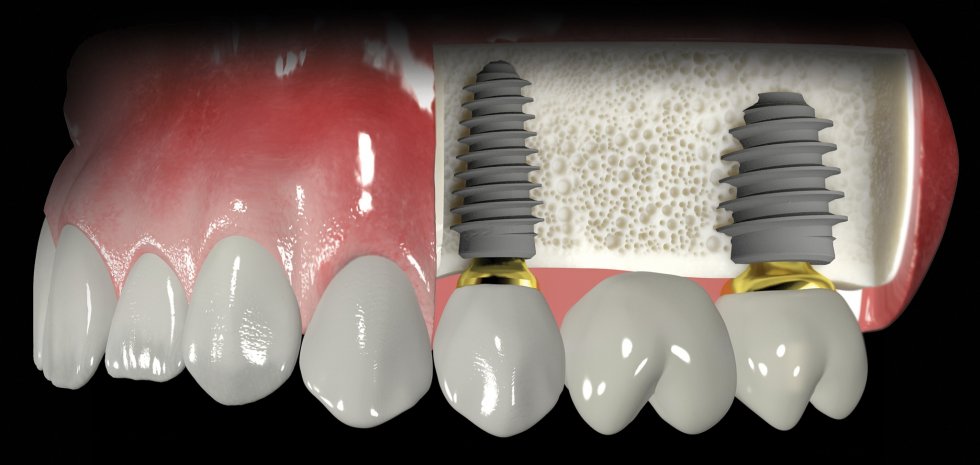 implant fiyatlari3