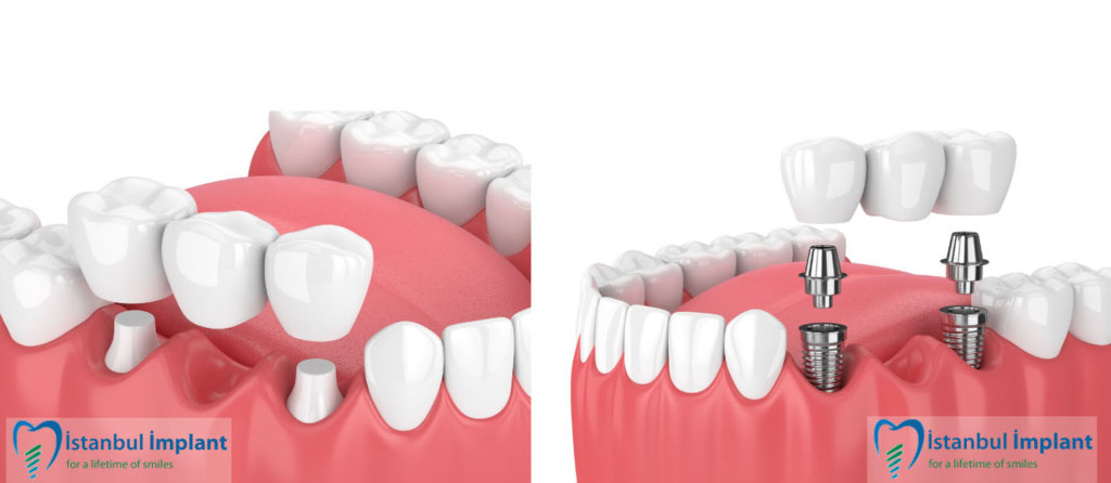 implant ile köprü arasındaki farklar