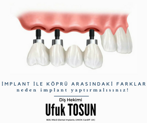 implant ile köprü arasındaki farklar