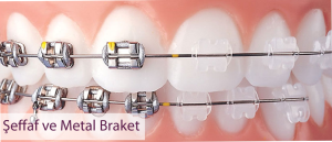 şeffaf braket