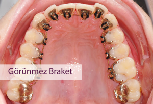 lingual braket