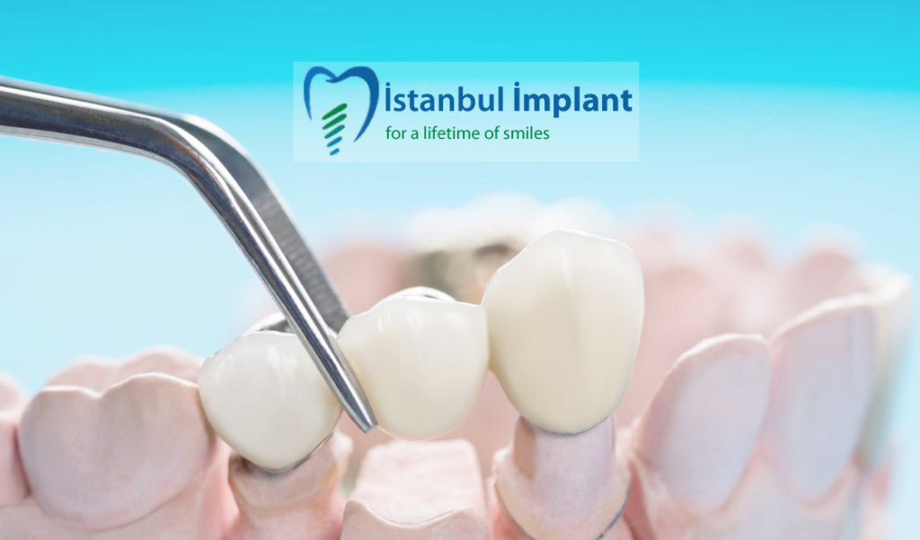 implant üzerine protez nasıl yerleşir