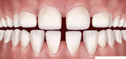 ayrık diş tedavisi