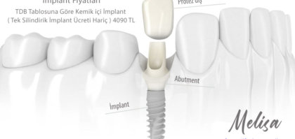 implant fiyatlari