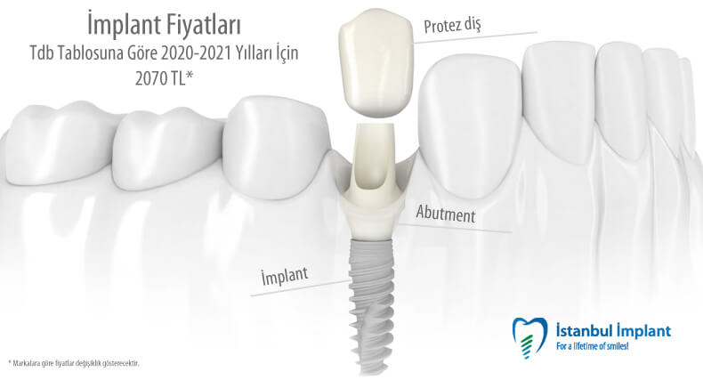 implant fiyatları